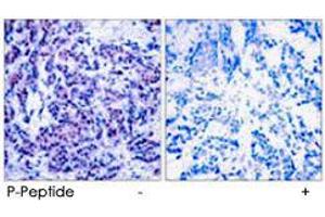 Immunohistochemical analysis of paraffin-embedded human breast carcinoma tissue using JUND (phospho S255) polyclonal antibody . (JunD 抗体  (pSer255))