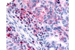 Anti-HRH4 / Histamine H4 Receptor antibody IHC of human Ovary, Carcinoma and Inflammatory Cells. (HRH4 抗体  (Cytoplasmic Domain))