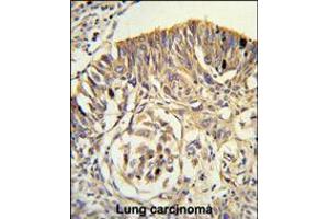 Formalin-fixed and paraffin-embedded human lung carcinoma reacted with PLTP Antibody , which was peroxidase-conjugated to the secondary antibody, followed by DAB staining. (PLTP 抗体  (C-Term))