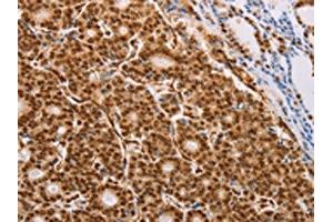 The image on the left is immunohistochemistry of paraffin-embedded Human thyroid cancer tissue using ABIN7130740(PSMD3 Antibody) at dilution 1/25, on the right is treated with fusion protein. (PSMD3 抗体)