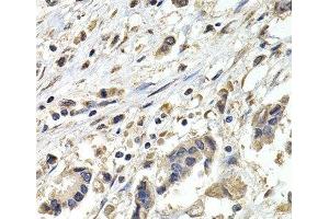 Immunohistochemistry of paraffin-embedded Human breast cancer using BUB1B Polyclonal Antibody at dilution of 1:200 (40x lens). (BUB1B 抗体)