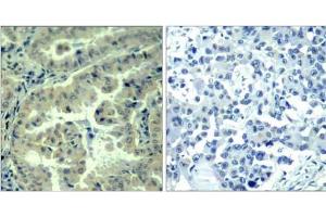 Immunohistochemical analysis of paraffin-embedded human lung carcinoma tissue using eIF4G (phospho-Ser1232) antibody (E011514). (EIF4G1 抗体  (pSer1232))