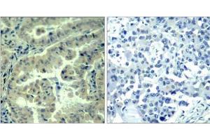 Immunohistochemical analysis of paraffin-embedded human lung carcinoma tissue using eIF4G (phospho-Ser1232) antibody (E011514). (EIF4G1 抗体  (pSer1232))