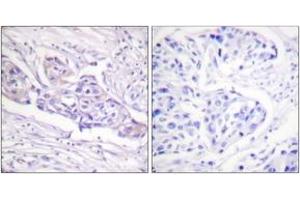 Immunohistochemistry analysis of paraffin-embedded human breast carcinoma, using FOXO1A (Phospho-Ser329) Antibody. (FOXO1 抗体  (pSer329))