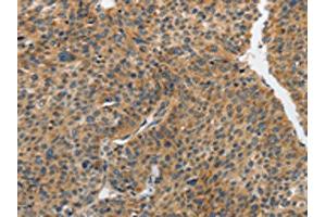 The image on the left is immunohistochemistry of paraffin-embedded Human liver cancer tissue using ABIN7191891(PIP5K1C Antibody) at dilution 1/25, on the right is treated with synthetic peptide. (PIP5K1C 抗体)