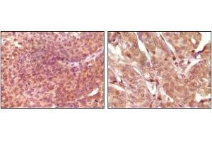 Immunohistochemical analysis of paraffin-embedded human bladder carcinoma (left) and breast carcinoma (right), showing nuclear and cytoplasmic localization using SRA antibody with DAB staining. (SRA1 抗体)