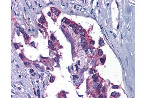 Anti-GFPT1 / GFAT antibody IHC of human Pancreas, Carcinoma. (GFPT1 抗体  (C-Term))