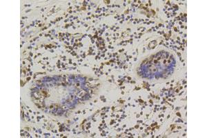 Immunohistochemistry of paraffin-embedded human mammary cancer using CREB1 antibody (ABIN5996963) at dilution of 1/100 (40x lens). (CREB1 抗体)