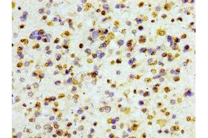 IHC image of ABIN7127295 diluted at 1:100 and staining in paraffin-embedded human glioma cancer performed on a Leica BondTM system. (Recombinant HIST1H3A 抗体)