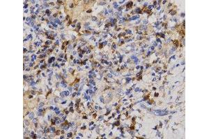 Immunohistochemistry of paraffin-embedded Human lung cancer using Eif2ak2 Polyclonal Antibody at dilution of 1:200 (40x lens).