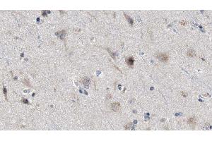 ABIN6277974 at 1/100 staining Human brain cancer tissue by IHC-P. (Presenilin 2 抗体  (Internal Region))