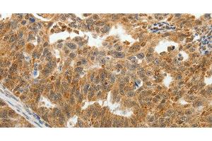 Immunohistochemistry of paraffin-embedded Human ovarian cancer tissue using SOCS7 Polyclonal Antibody at dilution 1:30 (SOCS7 抗体)