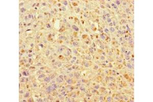 Immunohistochemistry of paraffin-embedded human melanoma using ABIN7157632 at dilution of 1:100 (KIF24 抗体  (AA 1168-1368))