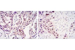 Immunohistochemical analysis of paraffin-embedded mammary cancer tissues (left) and lung cancer tissues (right) using STAT3 mouse mAb with DAB staining. (STAT3 抗体)