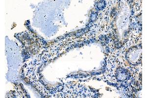 ABIN6258550 and ABIN6275237 at 1/100 staining Human ovarian cancer by IHC-P. (MRPS30 抗体  (C-Term))