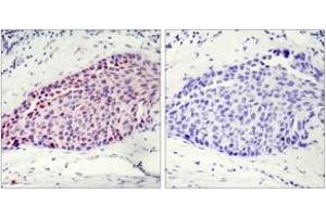 Immunohistochemistry analysis of paraffin-embedded human breast carcinoma tissue, using ATF2 (Ab-112 or 94) Antibody.