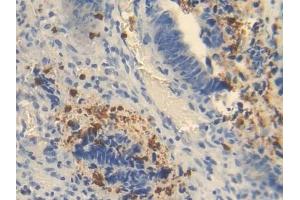 Detection of OTC in Human Colorectal cancer Tissue using Polyclonal Antibody to Ornithine Transcarbamylase (OTC) (OTC 抗体  (AA 78-129))