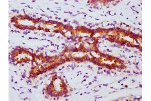 IHC image of ABIN7127694 diluted at 1:100 and staining in paraffin-embedded human breast cancer performed on a Leica BondTM system. (Recombinant FOXO3 抗体  (pSer253))