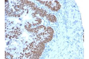 Formalin-fixed, paraffin-embedded human Colon Carcinoma stained with CDX2 Mouse Monoclonal Antibody (CDX2/2214). (CDX2 抗体)