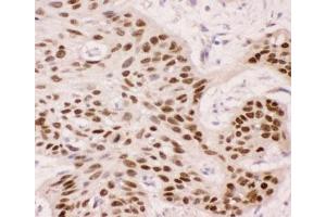 IHC-P: p63 antibody testing of human oesophagus squama cancer tissue (TCP1 alpha/CCTA 抗体  (AA 311-680))