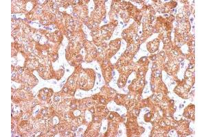 IHC-P Image Immunohistochemical analysis of paraffin-embedded human hepatoma, using GCP2, antibody at 1:500 dilution. (TUBGCP2 抗体  (N-Term))