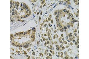 Immunohistochemistry of paraffin-embedded Human breast cancer using EBAG9 Polyclonal Antibody at dilution of 1:100 (40x lens). (RCAS1 抗体)
