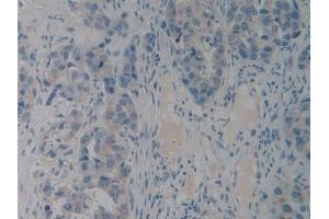 Detection of PACAP in Human Breast cancer Tissue using Polyclonal Antibody to Pituitary Adenylate Cyclase Activating Peptide (PACAP) (Pituitary Adenylate Cyclase Activating Peptide (AA 17-176) 抗体)