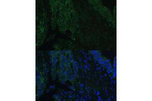Immunofluorescence analysis of human colon carcinoma using CLC Polyclonal Antibody (5041) at dilution of 1:100 (40x lens). (CLCA1 抗体  (AA 22-150))