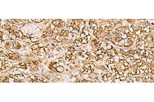 Immunohistochemistry of paraffin-embedded Human liver cancer tissue using MTAP Polyclonal Antibody at dilution of 1:70(x200)