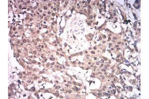 Immunohistochemical analysis of paraffin-embedded esophageal cancer tissues using ASH2L mouse mAb with DAB staining. (ASH2L 抗体  (AA 493-628))