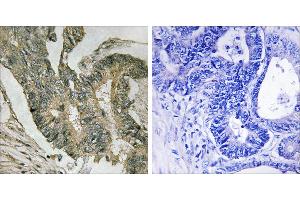 Peptide - +Immunohistochemistry analysis of paraffin-embedded human colon carcinoma tissue using ALDOC antibody. (ALDOC 抗体  (Internal Region))