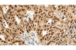 Immunohistochemistry of paraffin-embedded Human ovarian cancer tissue using SSB Polyclonal Antibody at dilution 1:50 (SSB 抗体)