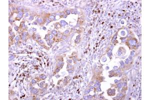 IHC-P Image LILRB5 antibody [N2C1], Internal detects LILRB5 protein at cytosol on human breast carcinoma by immunohistochemical analysis. (LILRB5 抗体  (Internal Region))
