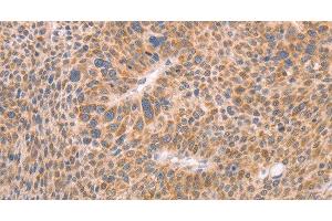 Immunohistochemistry of paraffin-embedded Human liver cancer using AASDHPPT Polyclonal Antibody at dilution of 1:30
