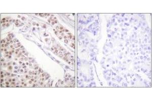 Immunohistochemistry analysis of paraffin-embedded human lung carcinoma tissue, using Histone H2B (Acetyl-Lys12) Antibody. (Histone H2B 抗体  (acLys12))
