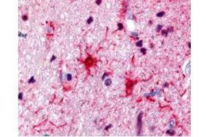 Rabbit anti-S100 was used at a 1:500 dilution to detect S100 by immunohistochemistry in human brain astrocyte tumor tissue. (S100 Protein (S100) 抗体)