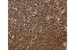Immunohistochemistry of Human colon cancer using EXTL3 Polyclonal Antibody at dilution of 1:50 (EXTL3 抗体)