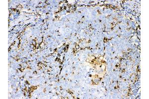 Iba1 was detected in paraffin-embedded sections of human lung cancer tissues using rabbit anti- Iba1 Antigen Affinity purified polyclonal antibody (Catalog # ) at 1 µg/mL. (Iba1 抗体  (C-Term))
