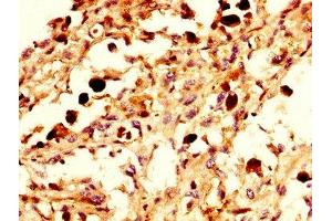 IHC image of ABIN7161390 diluted at 1:300 and staining in paraffin-embedded human melanoma performed on a Leica BondTM system. (NPAS4 抗体  (AA 445-585))