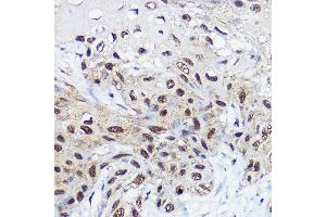 Immunohistochemistry of paraffin-embedded human esophageal cancer using SM Rabbit pAb (ABIN6132562, ABIN6148098, ABIN6148099 and ABIN6214424) at dilution of 1:100 (40x lens). (SMARCA1 抗体  (AA 1-200))