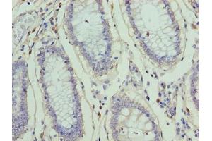 Immunohistochemistry of paraffin-embedded human colon cancer using ABIN7176373 at dilution of 1:100 (ZNF555 抗体  (AA 1-200))