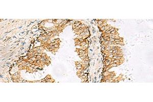 Immunohistochemistry of paraffin-embedded Human prost at e cancer tissue using SH3YL1 Polyclonal Antibody at dilution of 1:55(x200) (SH3YL1 抗体)