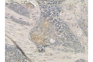 ABIN6257231 and ABIN6273685 at 1/100 staining human breast carcinoma by IHC-P. (Keratin 77 抗体  (Internal Region))