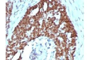 IHC testing of FFPE human ovarian carcinoma with Nucleolin antibody (clone NPC23-2). (Nucleolin 抗体)