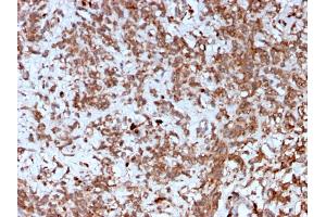 Formalin-fixed, paraffin-embedded human Liver stained with Cathepsin K Mouse Monoclonal Antibody (CTSK/2792). (Cathepsin K 抗体  (AA 163-274))