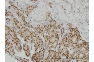 Immunoperoxidase of monoclonal antibody to PGR on formalin-fixed paraffin-embedded human breast cancer. (Progesterone Receptor 抗体  (AA 1-110))