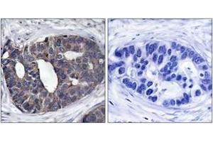 Immunohistochemistry analysis of paraffin-embedded human breast carcinoma tissue, using p62 Dok (Ab-362) Antibody. (DOK1 抗体  (AA 329-378))