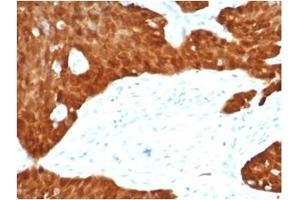 Formalin-fixed, paraffin-embedded human ovarian carcinoma stained with P16INK4a Recombinant Rabbit Monoclonal Antibody (CDKN2A/7081R). (Recombinant CDKN2A 抗体)