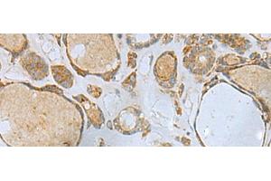 Immunohistochemistry of paraffin-embedded Human thyroid cancer tissue using ENKD1 Polyclonal Antibody at dilution of 1:80(x200) (ENKD1 抗体)
