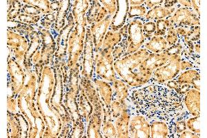 ABIN6260970 and ABIN6276865 at 1/100 staining Human kidney cancer and adjacent normal tissues by IHC-P.